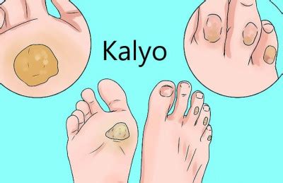 kalyo sa paa in english|Kalyo sa daliri ng paa in English with examples .